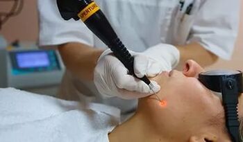 Un procedemento eficaz para eliminar o papiloma da cara cun láser