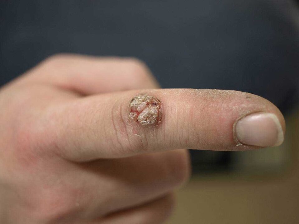 Verruga grande nun dedo que require eliminación