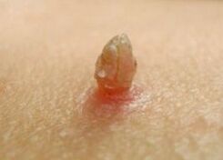 Papilloma afiado
