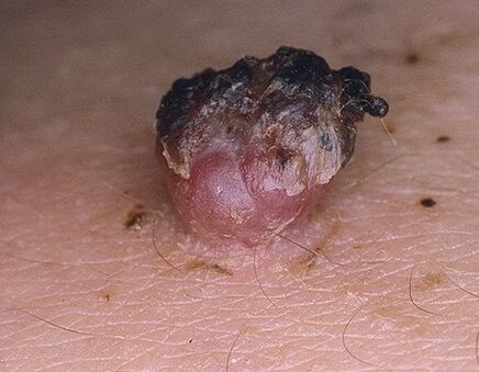 Papilloma ennegrecido