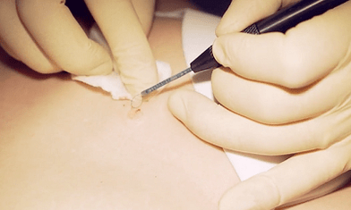 Eliminación cirúrxica da verruga plantar