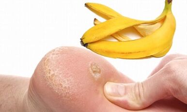 Pela de plátano para o tratamento dunha verruga plantar