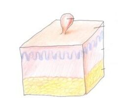 como se librar do papiloma no corpo