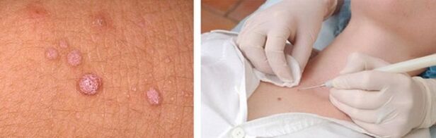 eliminación profesional de papilomas no corpo