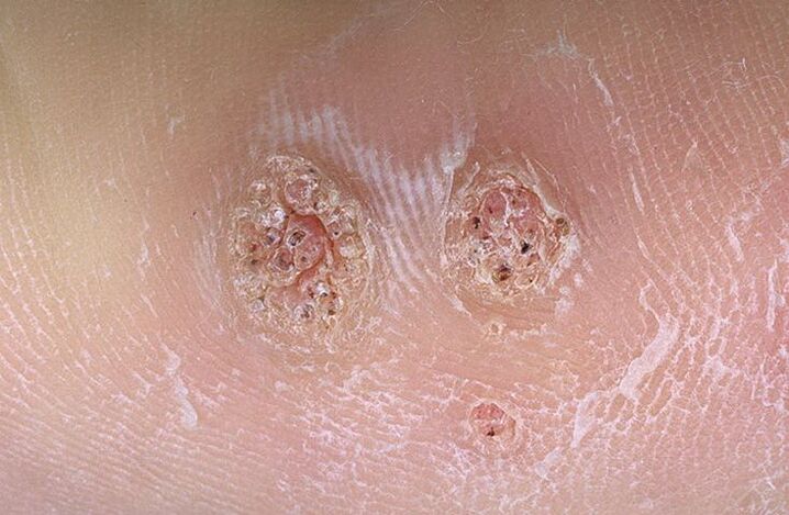 verrugas no corpo