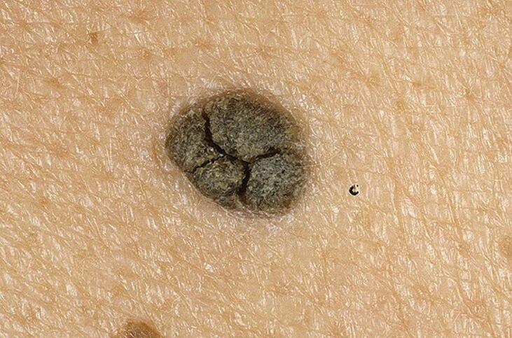 queratoma na pel do corpo
